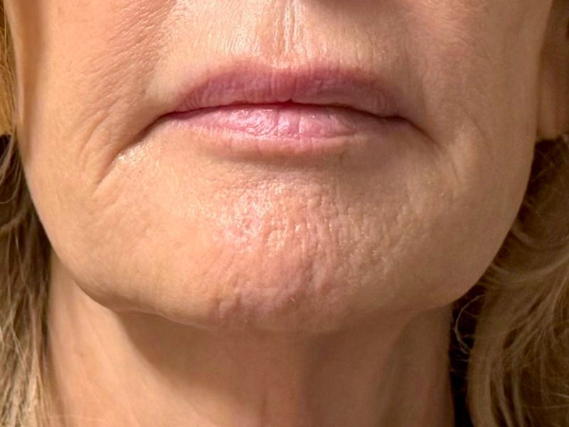 Hyperdilute Radiesse Before & After