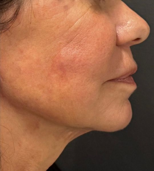 Hyperdilute Radiesse Before & After