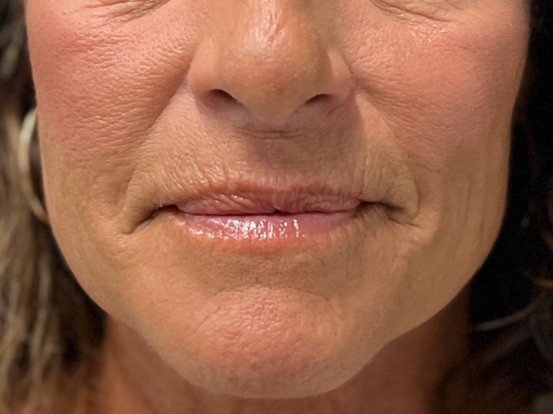 Hyperdilute Radiesse Before & After