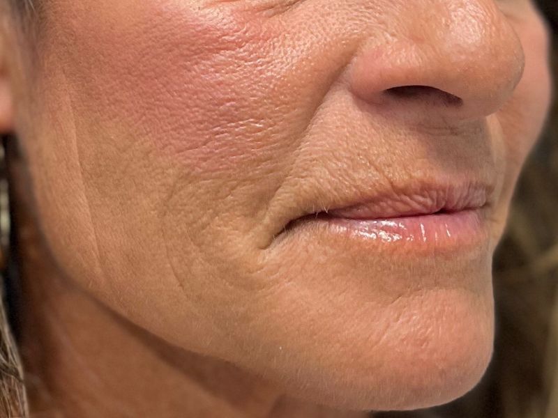 Hyperdilute Radiesse Before & After