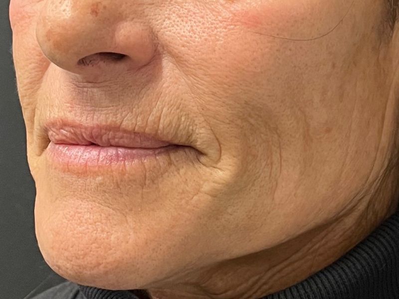 Hyperdilute Radiesse Before & After