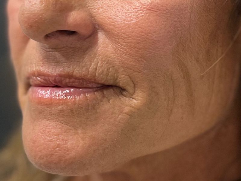 Hyperdilute Radiesse Before & After