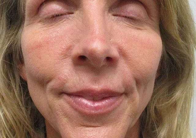 Morpheus8 Before & After