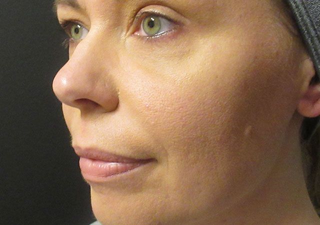 Morpheus8 Before & After