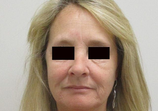 Morpheus8 Before & After