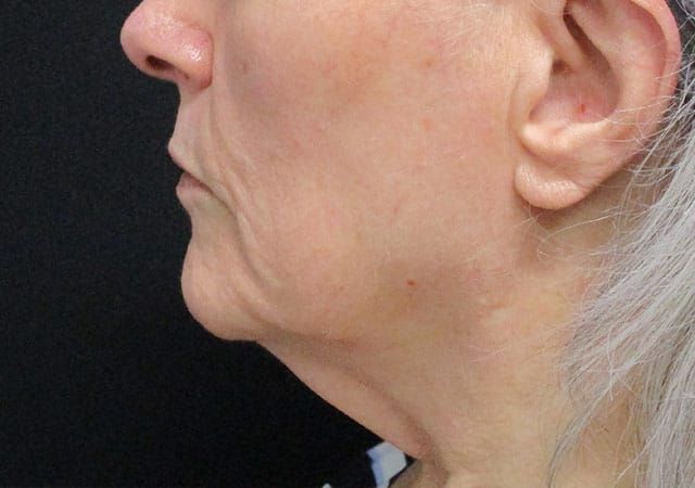 Morpheus8 Before & After