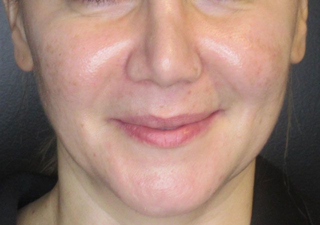 Morpheus8 Before & After