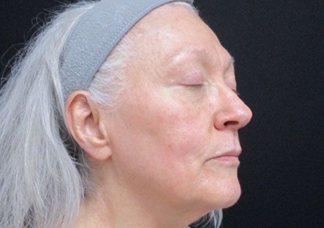 Morpheus8 Before & After