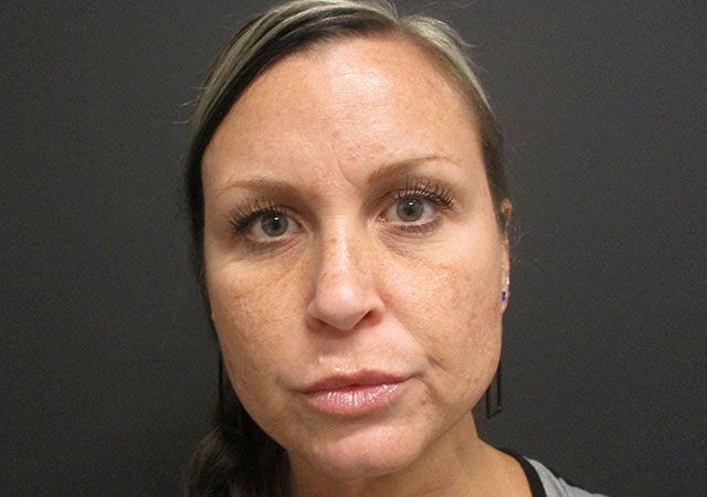 Morpheus8 Before & After