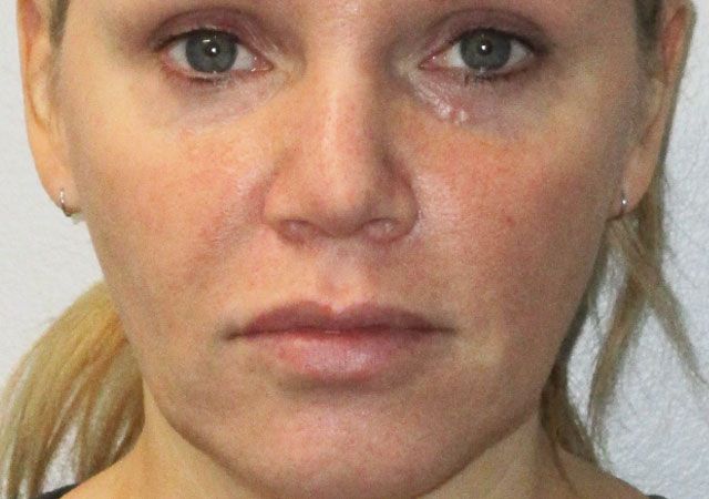 Morpheus8 Before & After