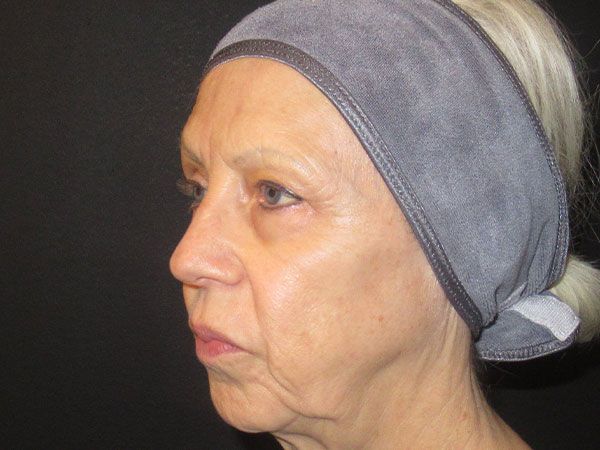 Morpheus8 Before & After