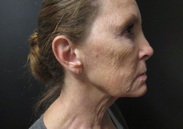 Morpheus8 Before & After