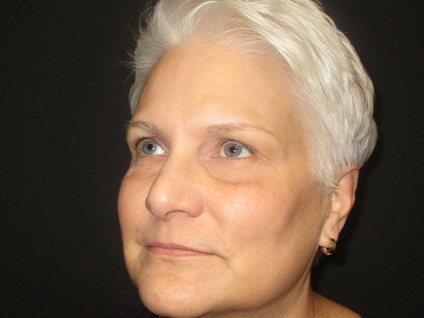 Morpheus8 Before & After