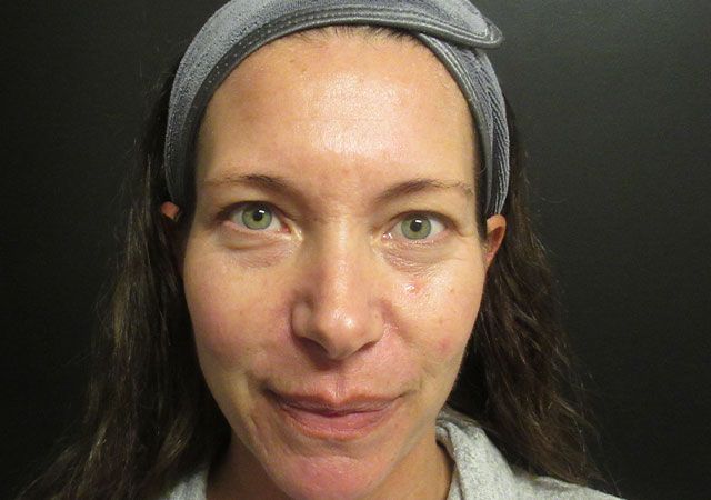 Morpheus8 Before & After