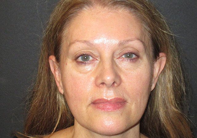 Morpheus8 Before & After