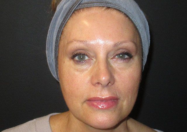 Morpheus8 Before & After