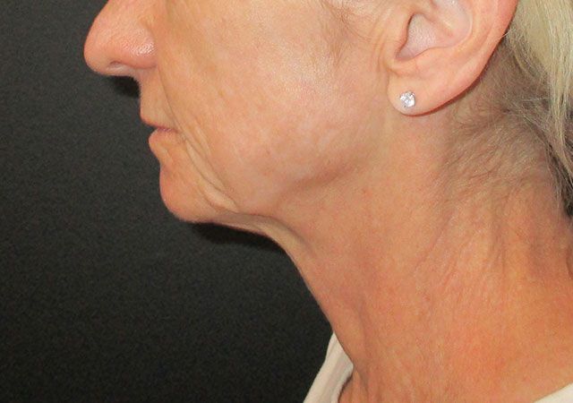 Morpheus8 Before & After