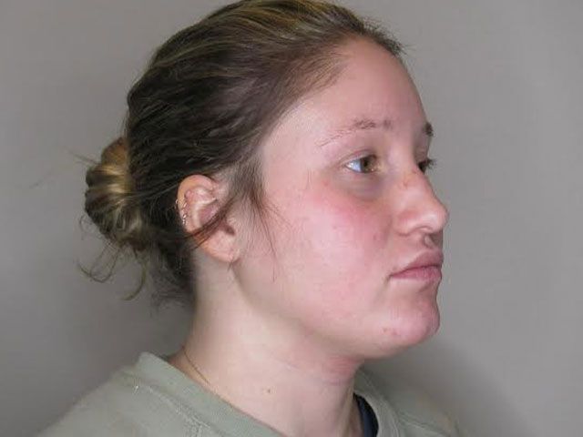 Morpheus8 Before & After