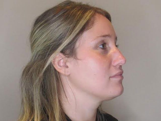 Morpheus8 Before & After