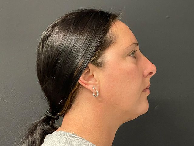 Morpheus8 Before & After