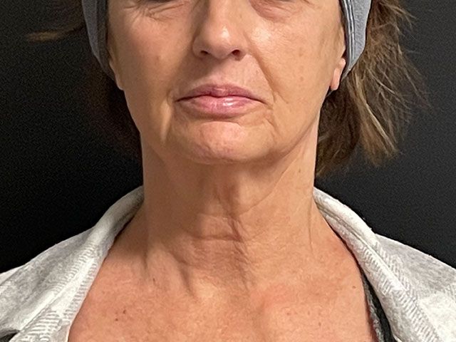 Morpheus8 Before & After