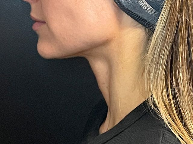 Morpheus8 Before & After