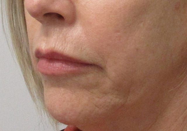 Morpheus8 Before & After