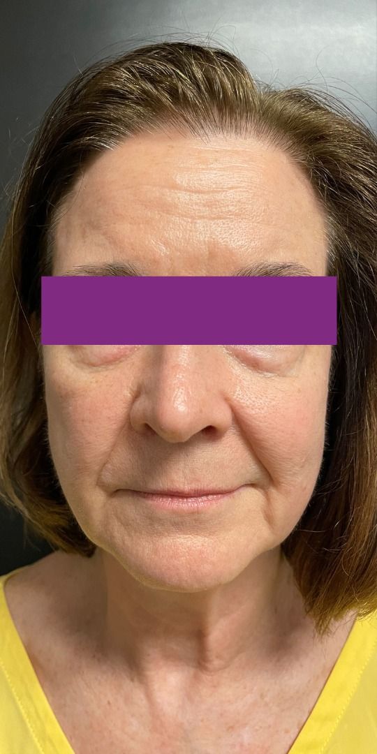 Morpheus8 Face Before & After