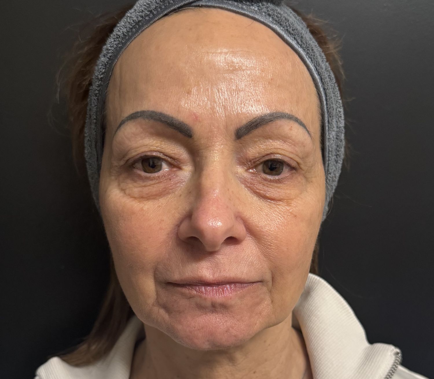 Morpheus8 Face Before & After