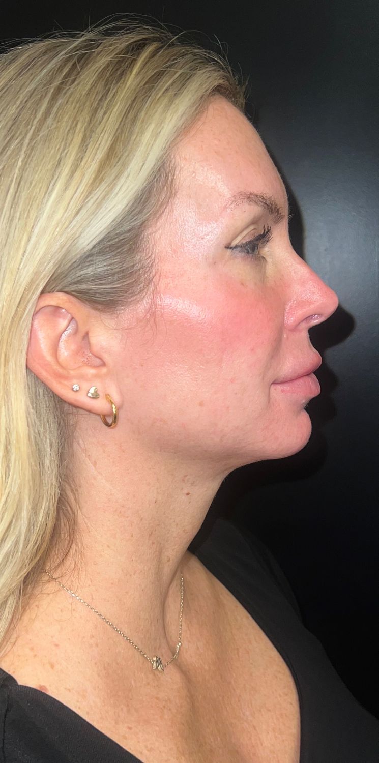 Morpheus8 Face Before & After