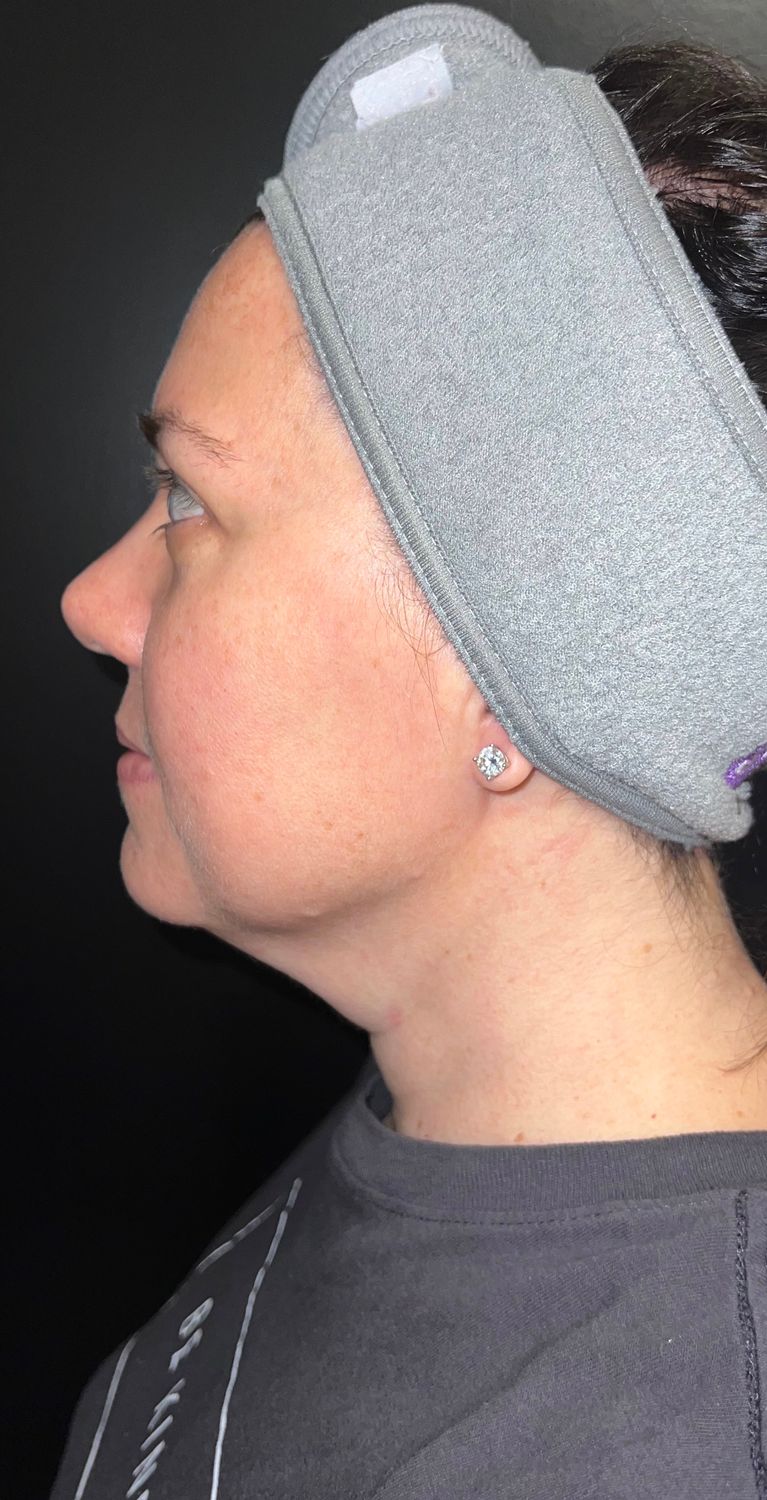 Morpheus8 Face Before & After