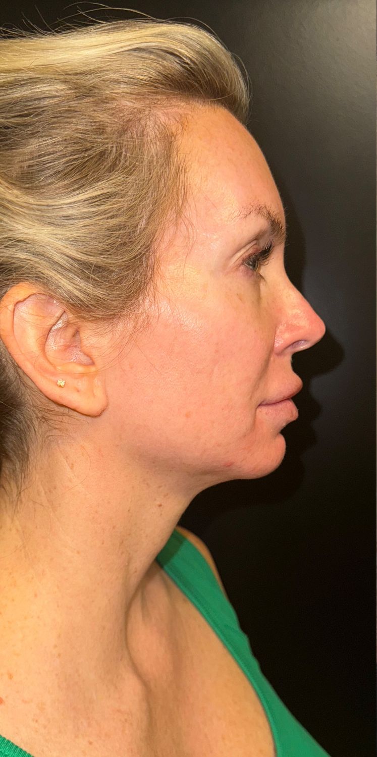 Morpheus8 Face Before & After