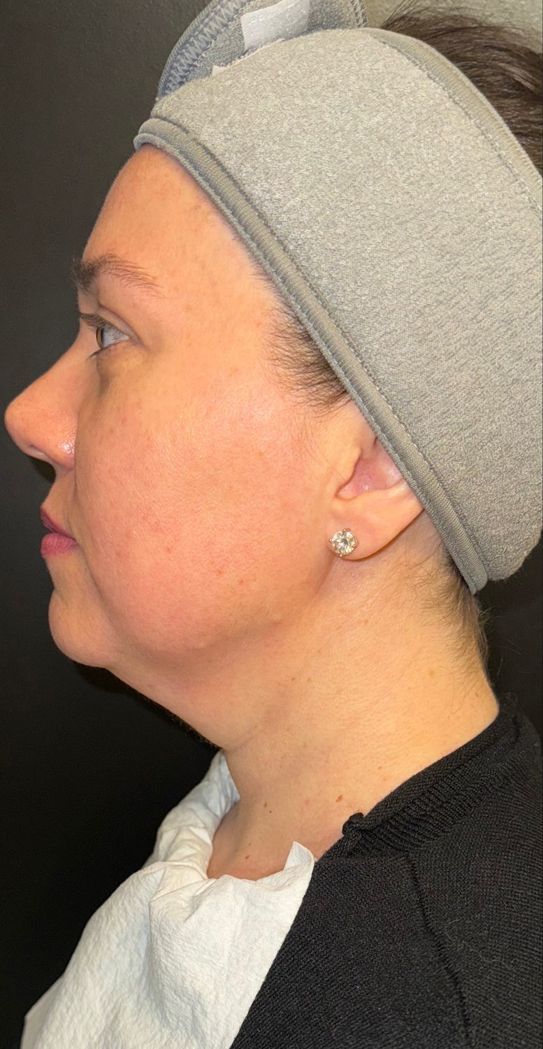 Morpheus8 Face Before & After