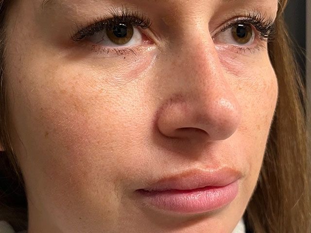 Cheeks Before & After