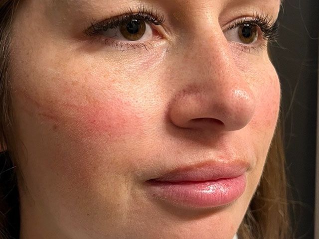 Cheeks Before & After