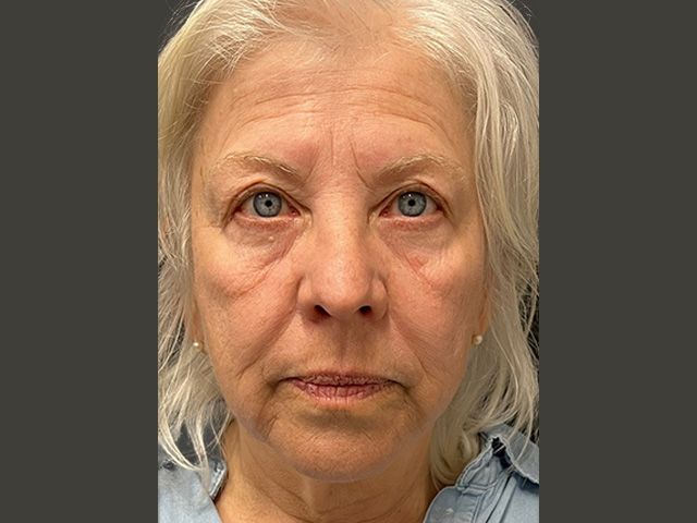 Cheeks Before & After