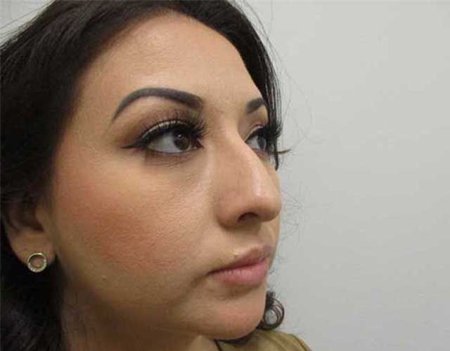 Cheeks Before & After