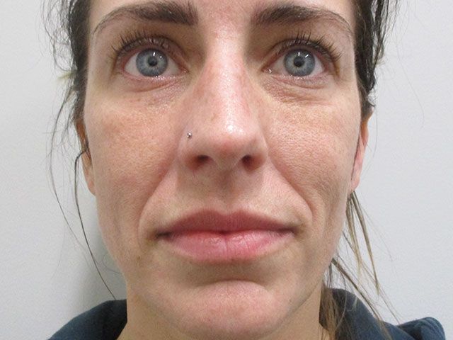 Cheeks Before & After