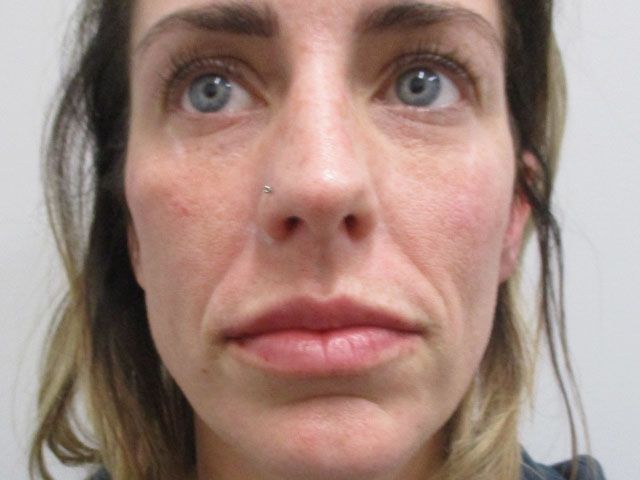 Cheeks Before & After