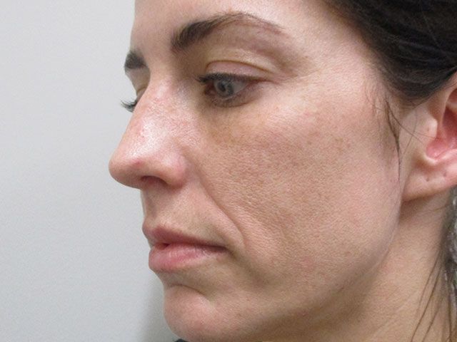 Cheeks Before & After