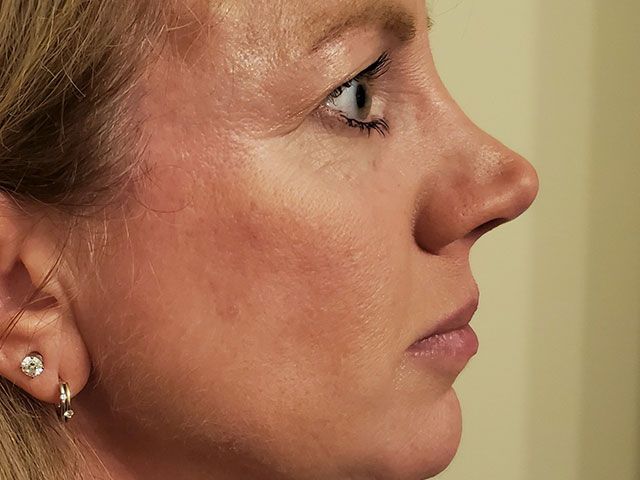 Cheeks Before & After