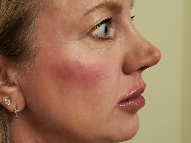 Cheeks Before & After