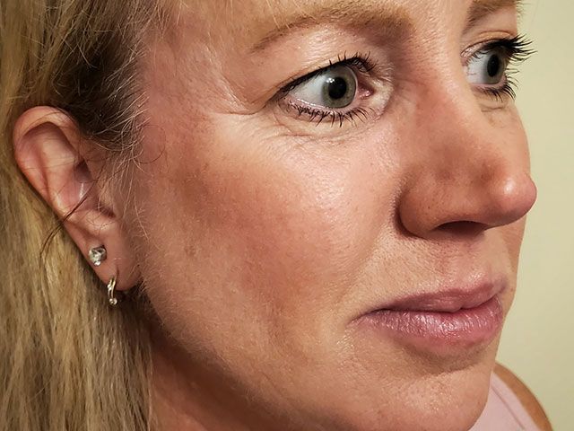 Cheeks Before & After