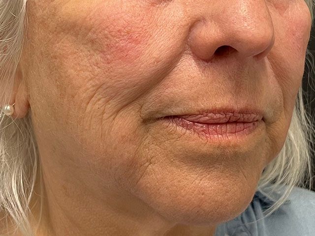 Cheeks Before & After