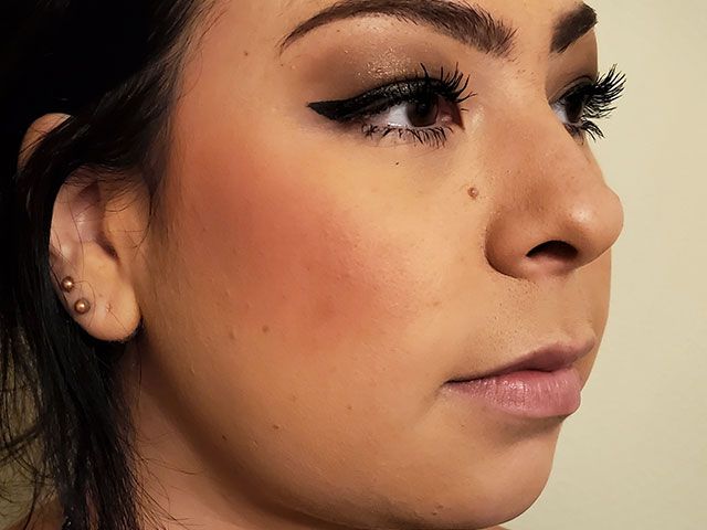 Cheeks Before & After