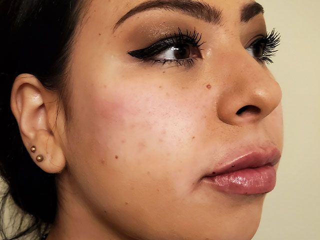 Cheeks Before & After