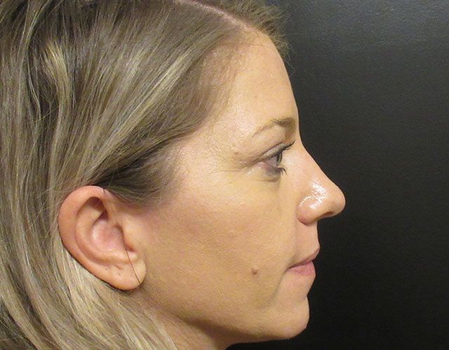 Cheeks Before & After