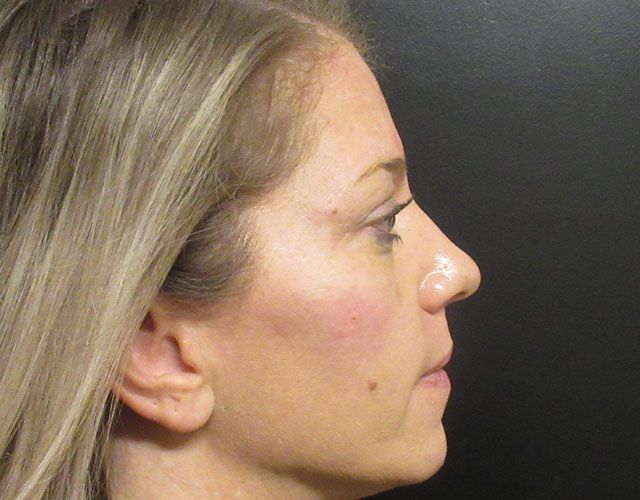 Cheeks Before & After