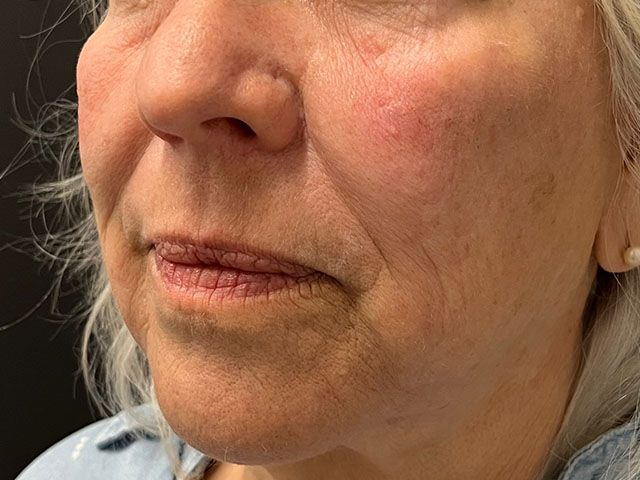 Cheeks Before & After