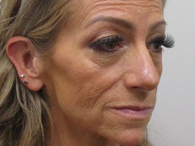 Cheeks Before & After